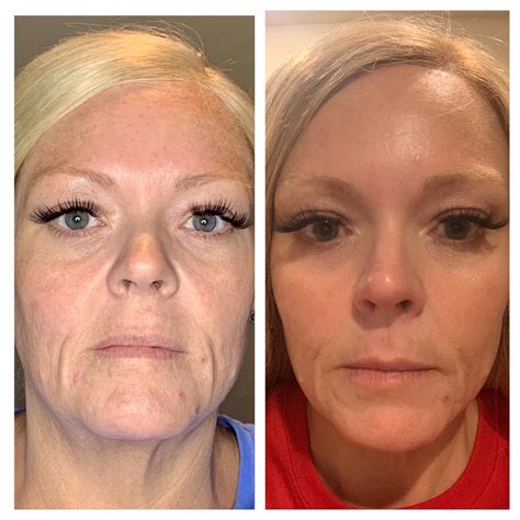 Vampire Facelift - Austin Regenerative Therapy