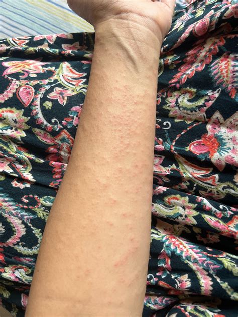 Tiny raised bumps on arms, chest, stomach spreading up the body : r