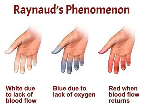 raynauds phenomenon medizzy