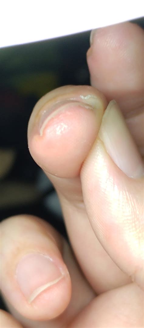 Is this beginning of a wart？ : r/Warts