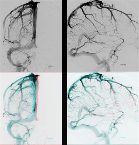 Dural Venous Channels | neuroangio.org