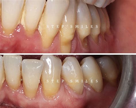 Gum Tissue Graft Surgery - procedure, causes, techniques and more