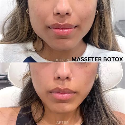 masseter botox      journey