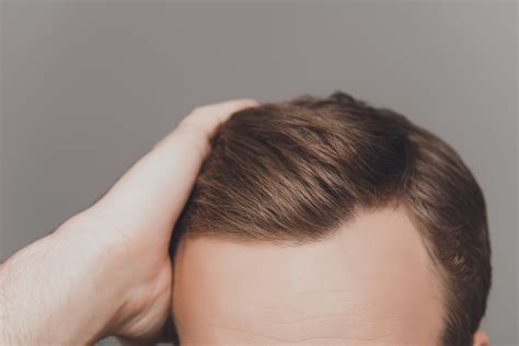 hair loss in temples women 13