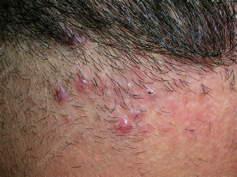 life changing acne keloidalis nuchae surgery healthehcom