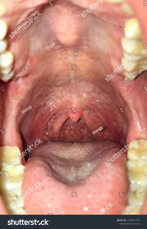 Oral Cavity Open Mouth Anatomy After Stock Photo (Edit Now) 1158961735