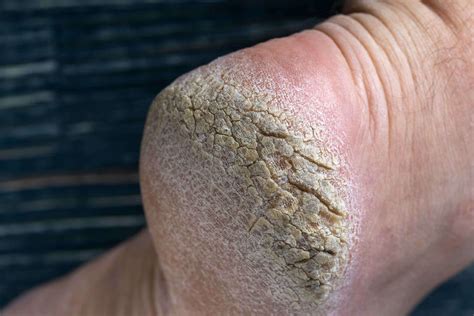 The Truth About Vaseline and Heel Cracks - Well Heeled Podiatry