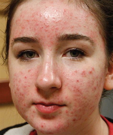 [DIAGRAM] Diagram Of Acne - MYDIAGRAM.ONLINE