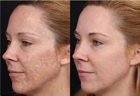 PRX T33 Medical Grade Chemical Peel - Sean Holt Clinic Botox Norwich