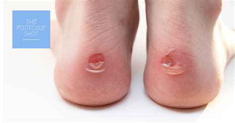 blisters   treat  prevent blisters