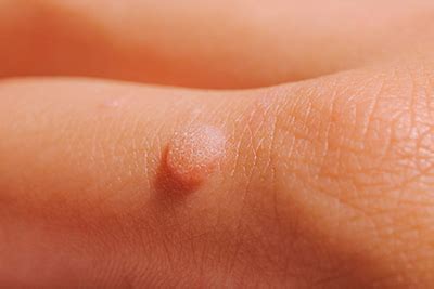 warts dermatologist  paducah ky benton ky martin tn paducah