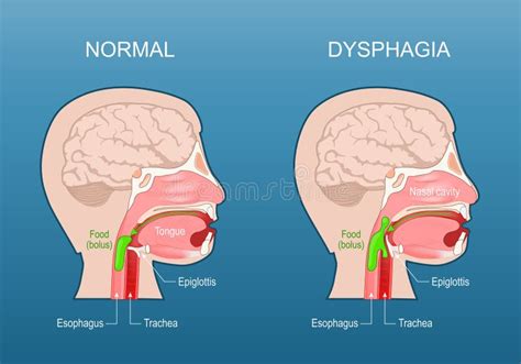 dysphagia swallowing difficulty aspiration stock vector