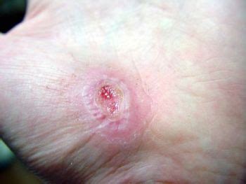 Epithelial Tissue Wound