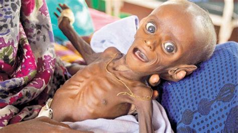 Number of Malnourished Children in Somalia Rose 40% in Feb | Business ...