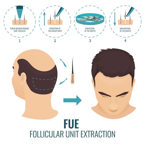 Hair Loss Solution - FUE Hair Transplant | Dr Chen Tai Ho | Malaysia