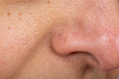 how to clear nose blackheads