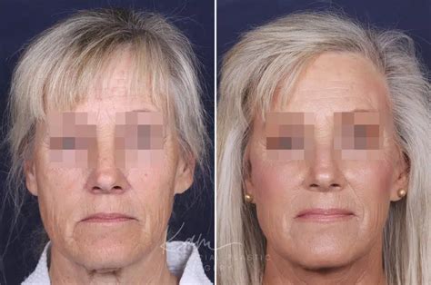 facelift  voorhees sewell nj kam facial plastic surgery