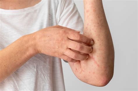 Staph Infection and Eczema: Causes and Treatment Options - Popado – Life & Health Hub ...