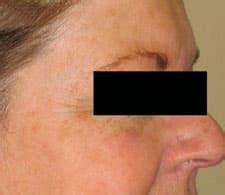 Photorejuvenation before after pictures|B/A photos of photorejuvenation