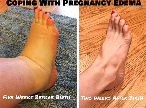 How to Manage Massive Pregnancy Swelling — First Thyme Mom | Pregnancy ...