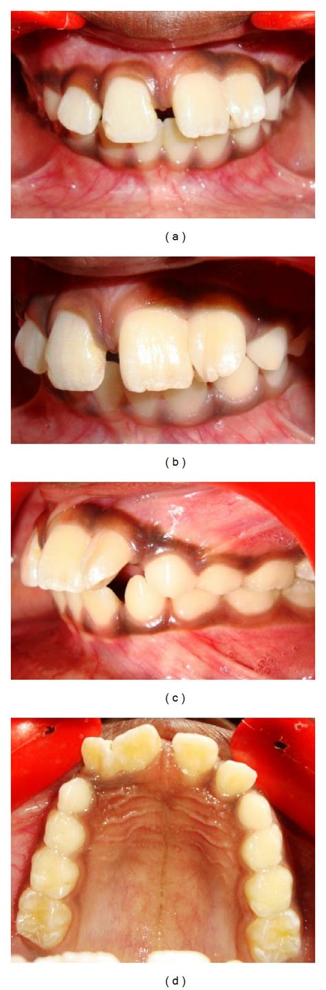 surgical  orthodontic management  fused maxillary central