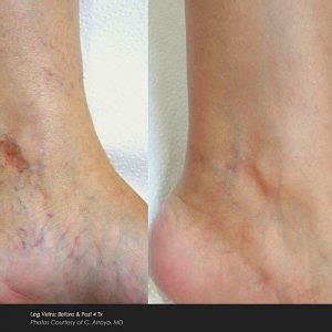 Laser Spider Vein Removal - Beautiful U Kamloops