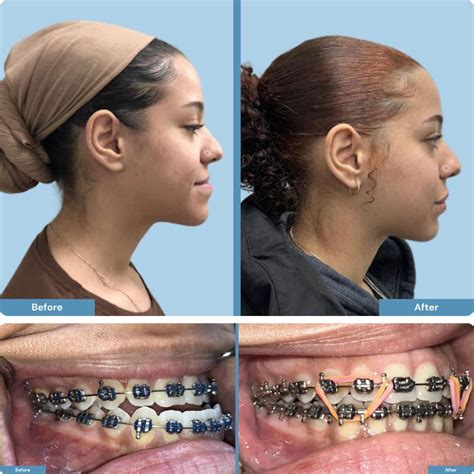 jaw surgery orthognathic jaw surgery    ufgqm
