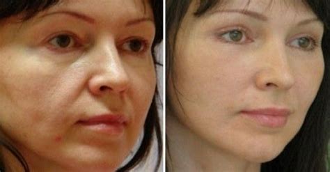Со временем наша кожа теряет упругость и эластичность, как следствие ...