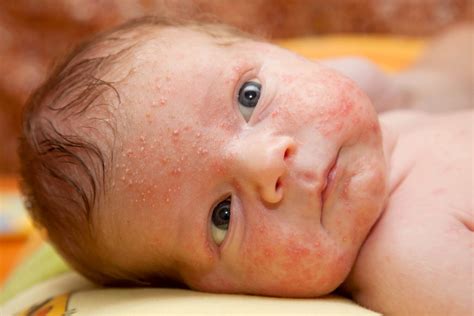 Baby Eczema vs Other Skin Conditions - Blueberry Pediatrics