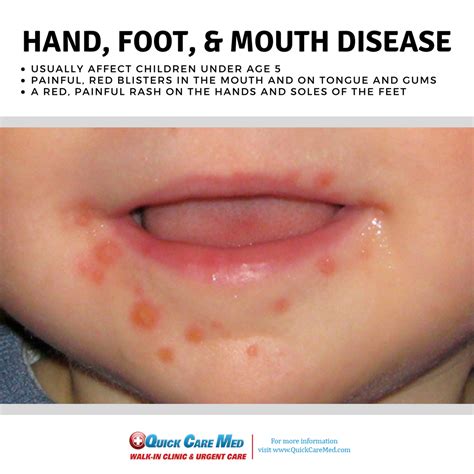 Top 97+ Pictures Photos Of Hand Foot And Mouth In Adults Superb