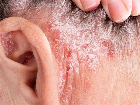 Rash behind ear: Causes, other symptoms, and treatment