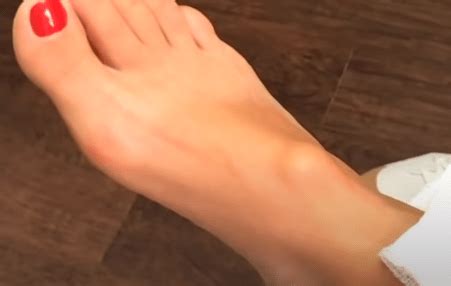 Ganglion Cyst Foot Treatments: Your Ultimate Guide - Newman Feet