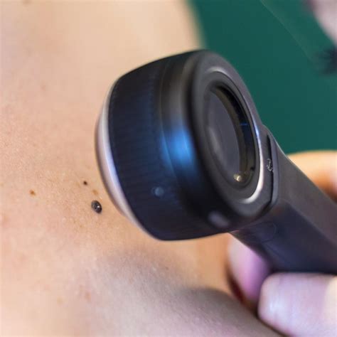 Dermatoscopia O Que É - Dermatoscopia | A.C.Camargo Cancer Center