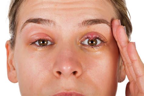 Eyelid Swollen: Symptoms, Causes, Treatment - Angleton ER