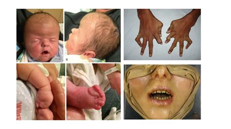 Giang mai bẩm sinh có nguy hiểm không? Phát hiện & điều trị