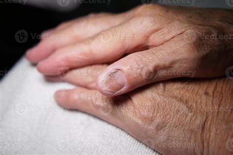 Fingernail of an elderly woman infected with fungal infection. 8060121 ...