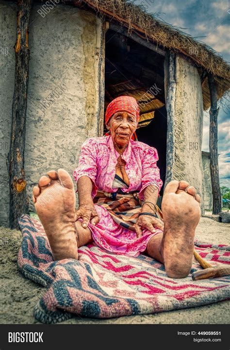 Black Legs In The Elderly at Emma Juergens blog