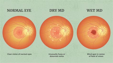 wet  dry age related macular degeneration amd