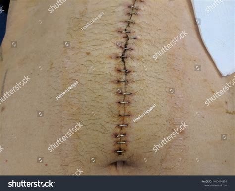 Rectal Cancer Incision After Surgery Gastrointestinal写真素材1400414354