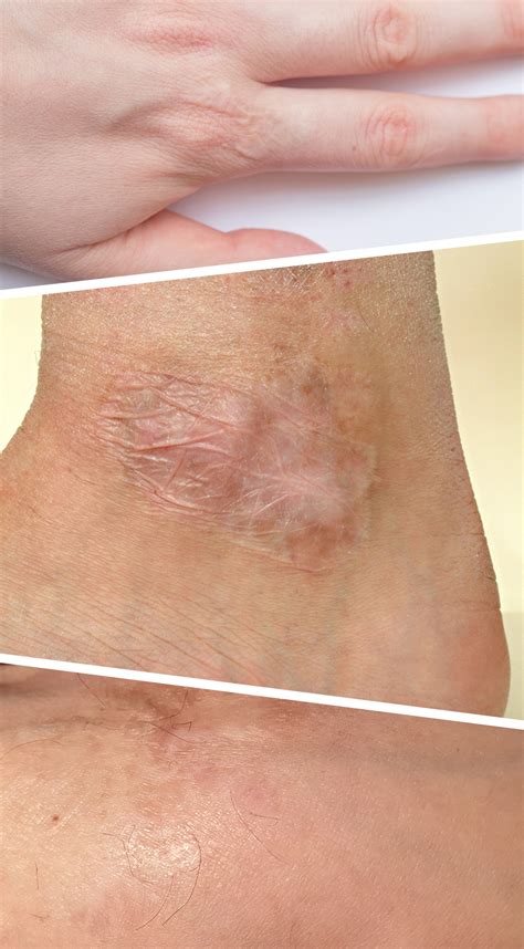 Adhesive Skin Burn at Robert Beck blog
