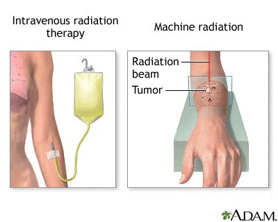 Radiation sickness | UF Health, University of Florida Health