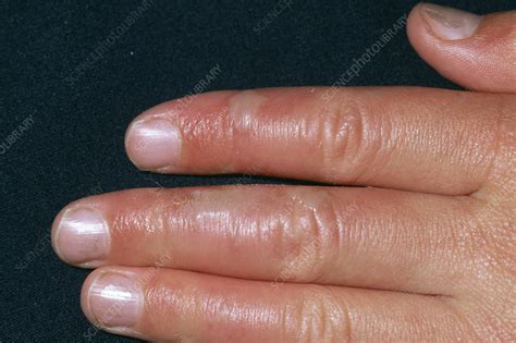 skin infection stock image  science photo library