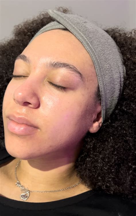 DermaQuest Chemical Peels Wolverhampton | Eterno Skin Clinic