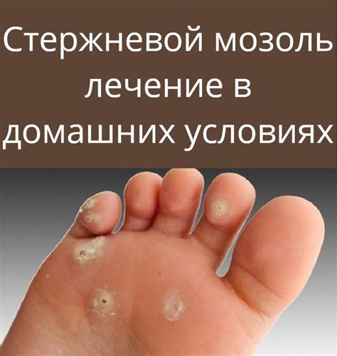Стержневой мозоль лечение в домашних условиях | Лечение, Домашние ...