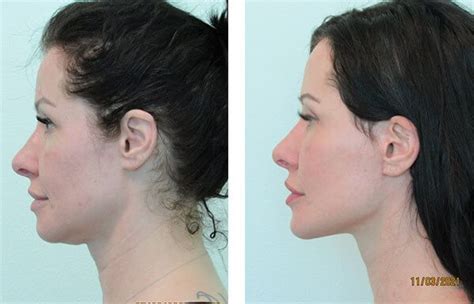 How Much is Chin Augmentation? | The Lafranchi Center