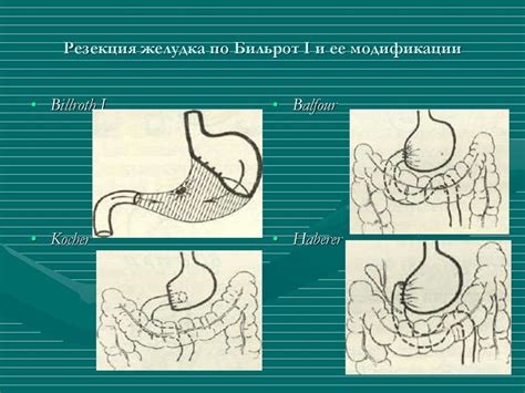 Болезни оперированного желудка. Резекция желудка - online presentation