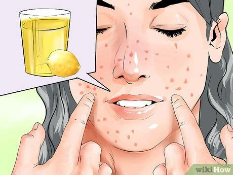 Outrageous Tips About How To Avoid Chicken Pox Scars - Treecurve