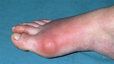 rates  gout  uk soaring bbc news