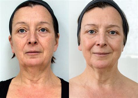 face lift laser