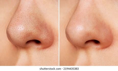 Closeup Womans Nose Blackheads Before After Stock Photo 2194435383 ...